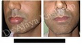 Lip Reduction